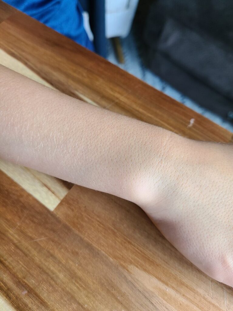 forearm completely healed from rash