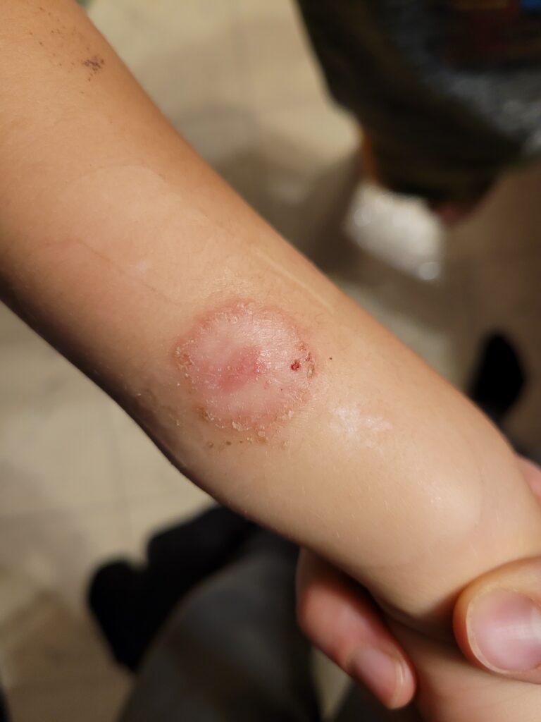 young Childs lower arm with large blister from wild parsnip plant