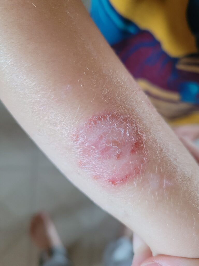 young Childs lower arm with large blister from wild parsnip plant